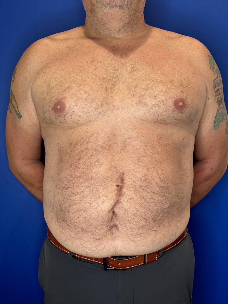 Abdominoplasty Before & After Gallery - Patient 383053 - Image 1