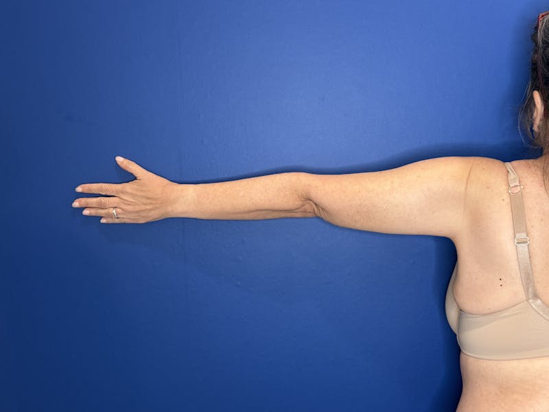 Arm Lift Before & After Gallery - Patient 303342 - Image 8