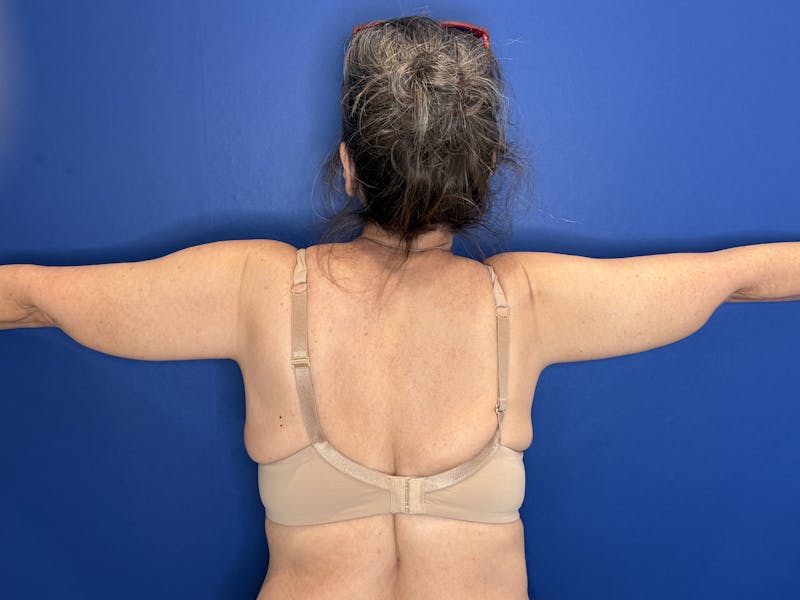 Arm Lift Before & After Gallery - Patient 303342 - Image 10