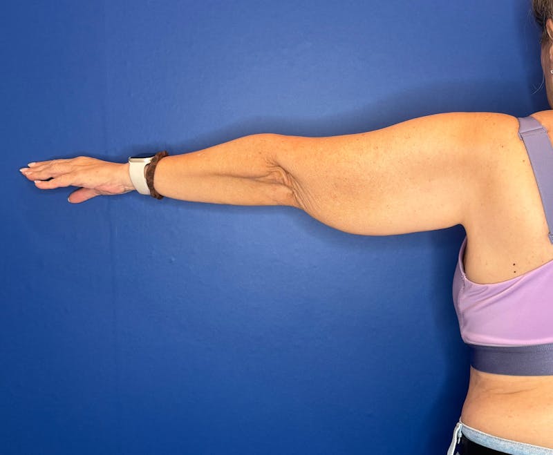 Arm Lift Before & After Gallery - Patient 303342 - Image 7
