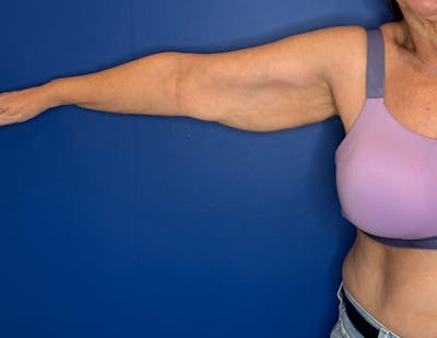 Arm Lift Before & After Gallery - Patient 303342 - Image 1