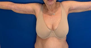 Arm Lift Before & After Gallery - Patient 303342 - Image 6