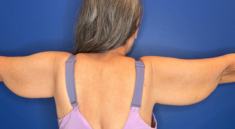Arm Lift Before & After Gallery - Patient 303342 - Image 9