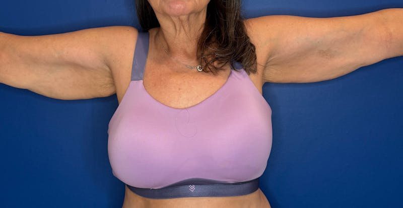 Arm Lift Before & After Gallery - Patient 303342 - Image 5