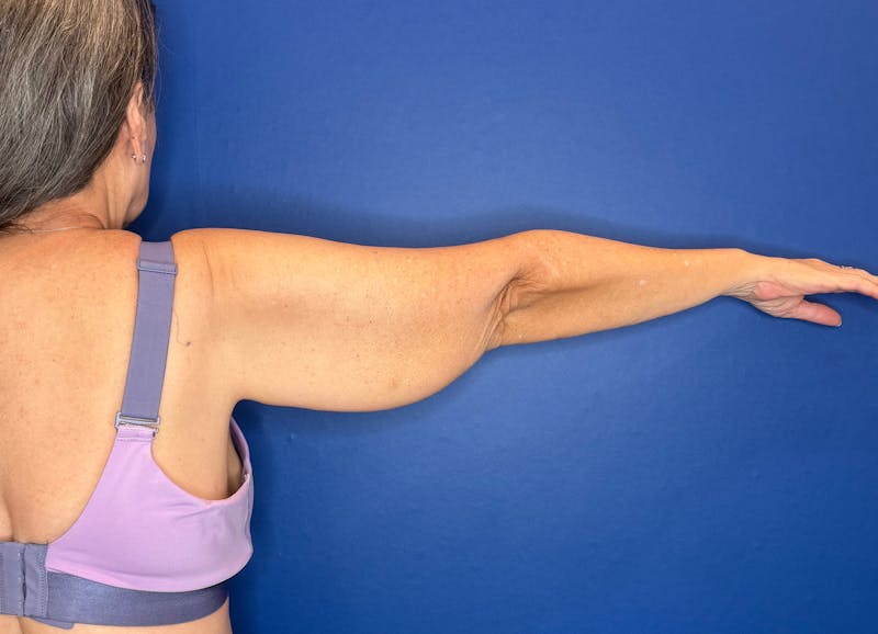 Arm Lift Before & After Gallery - Patient 303342 - Image 3