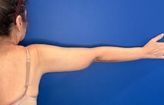 Arm Lift Before & After Gallery - Patient 303342 - Image 4