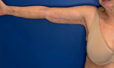 Arm Lift Before & After Gallery - Patient 303342 - Image 2