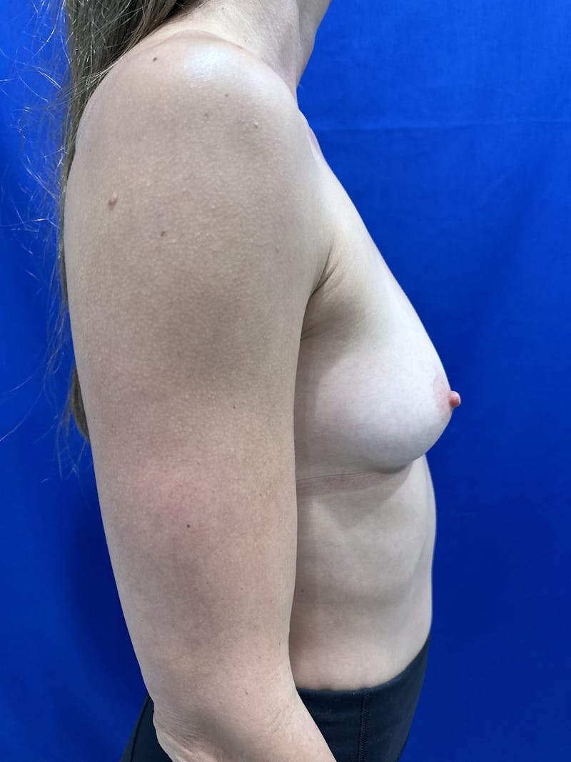 Breast Augmentation Before & After Gallery - Patient 353059 - Image 9