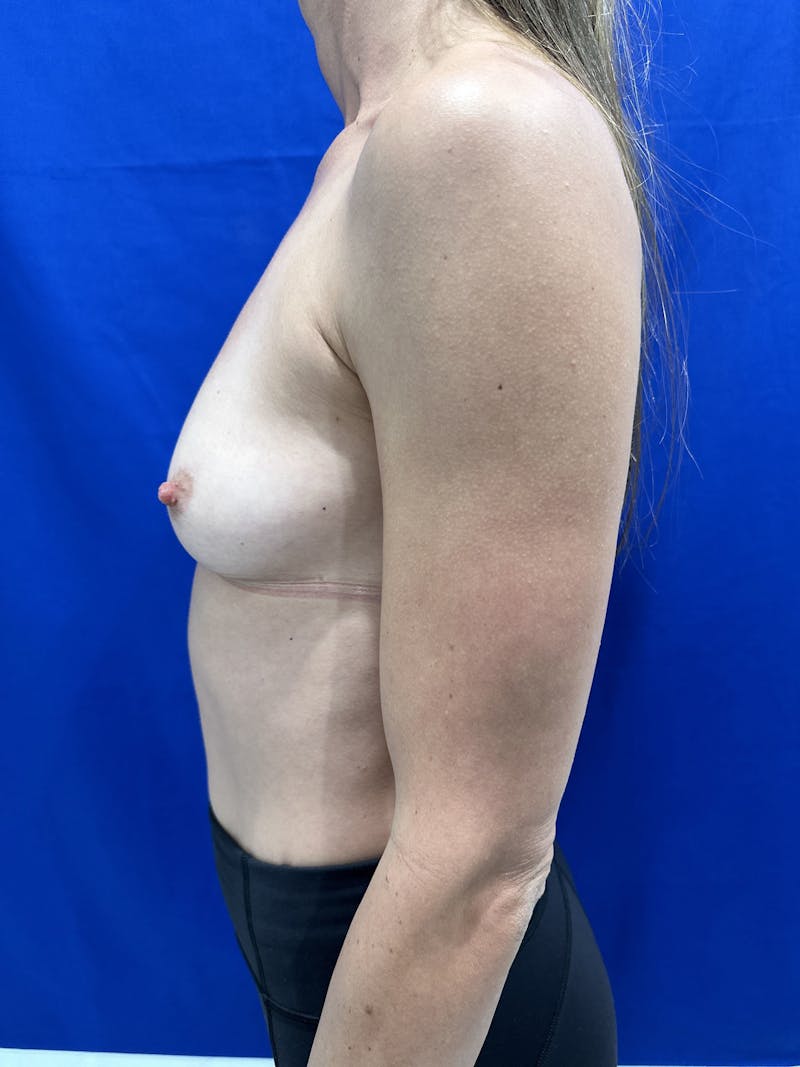 Breast Augmentation Before & After Gallery - Patient 353059 - Image 3