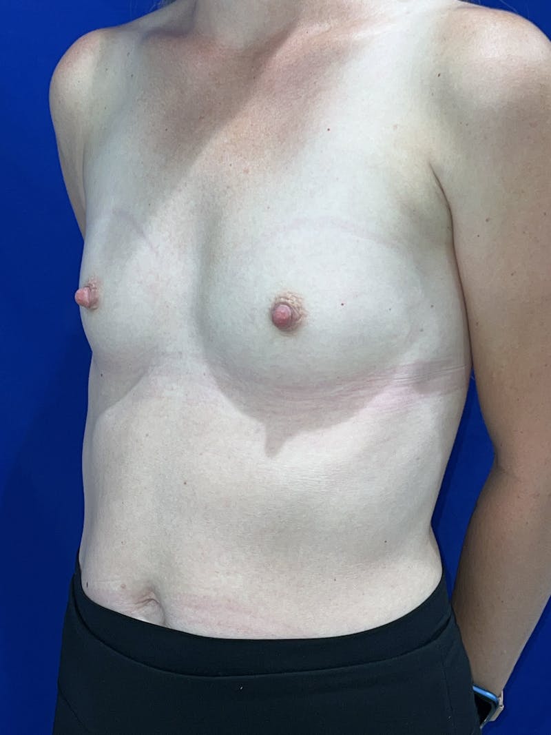 Breast Augmentation Before & After Gallery - Patient 325708 - Image 9