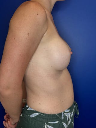 Breast Augmentation Before & After Gallery - Patient 325708 - Image 8