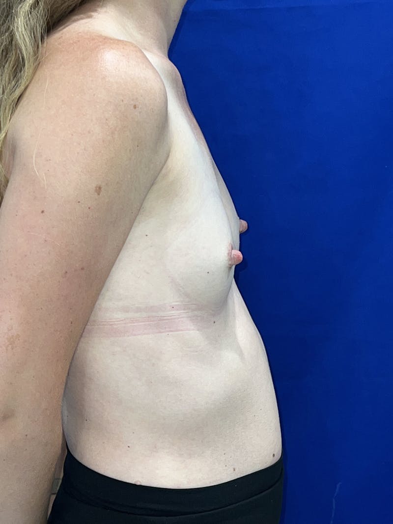 Breast Augmentation Before & After Gallery - Patient 325708 - Image 7