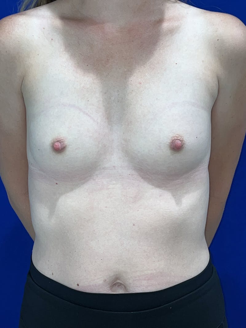 Breast Augmentation Before & After Gallery - Patient 325708 - Image 3