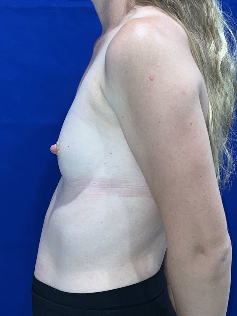 Breast Augmentation Before & After Gallery - Patient 325708 - Image 5
