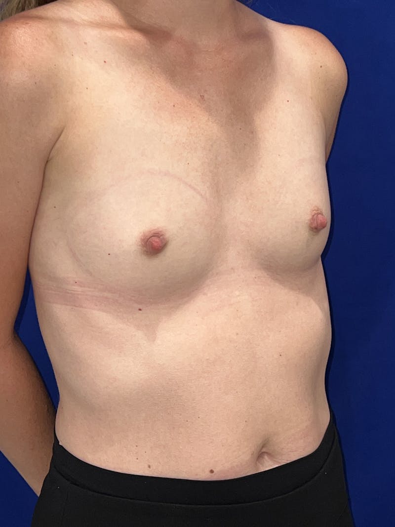 Breast Augmentation Before & After Gallery - Patient 325708 - Image 1