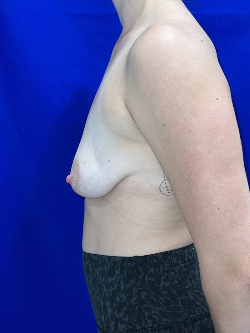 Breast Augmentation Before & After Gallery - Patient 114243 - Image 5