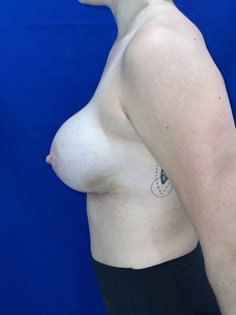Breast Augmentation Before & After Gallery - Patient 114243 - Image 6