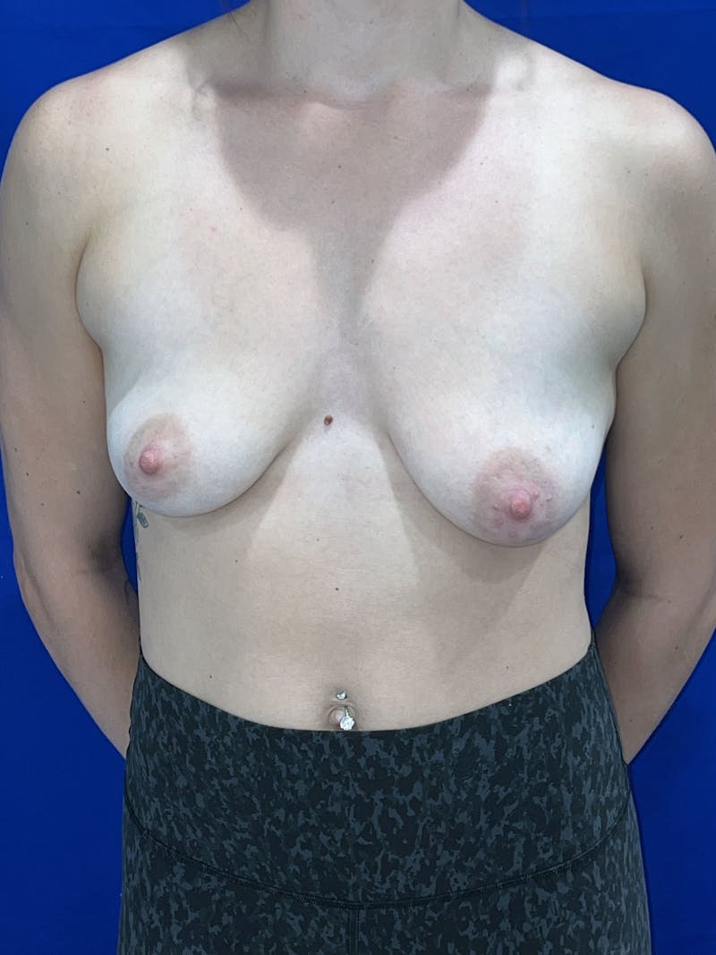 Breast Augmentation Before & After Gallery - Patient 114243 - Image 3
