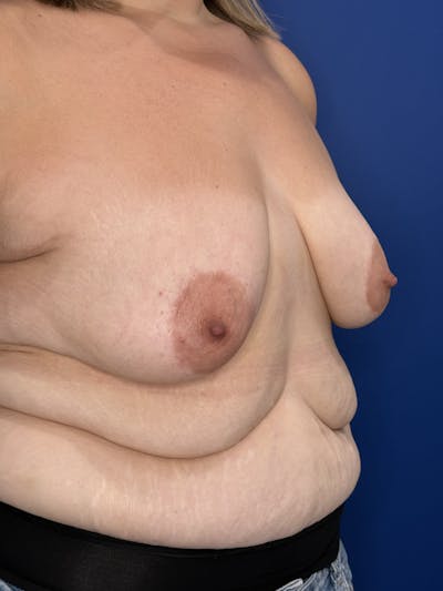 Breast Augmentation Before & After Gallery - Patient 306381 - Image 1