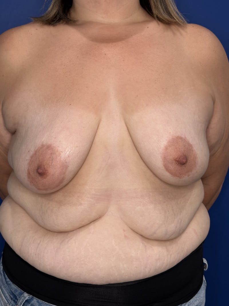 Breast Augmentation Before & After Gallery - Patient 306381 - Image 5