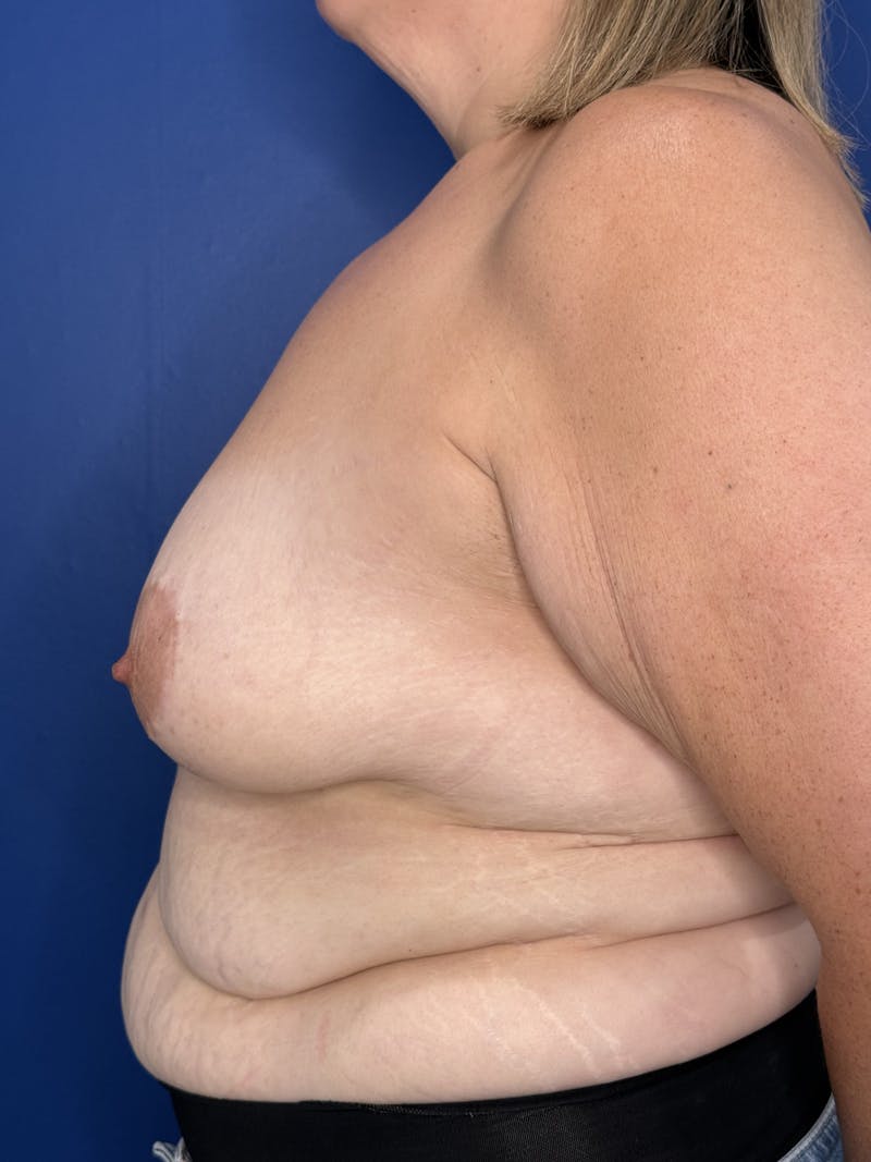 Breast Augmentation Before & After Gallery - Patient 306381 - Image 9