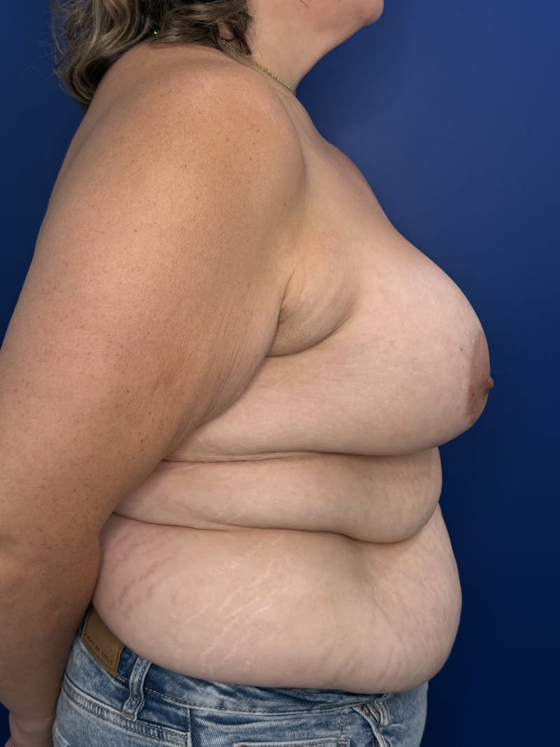 Breast Augmentation Before & After Gallery - Patient 306381 - Image 4