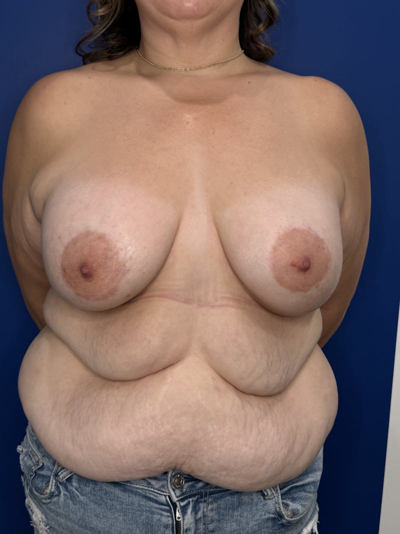 Breast Augmentation Before & After Gallery - Patient 306381 - Image 6