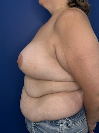 Breast Augmentation Before & After Gallery - Patient 306381 - Image 10
