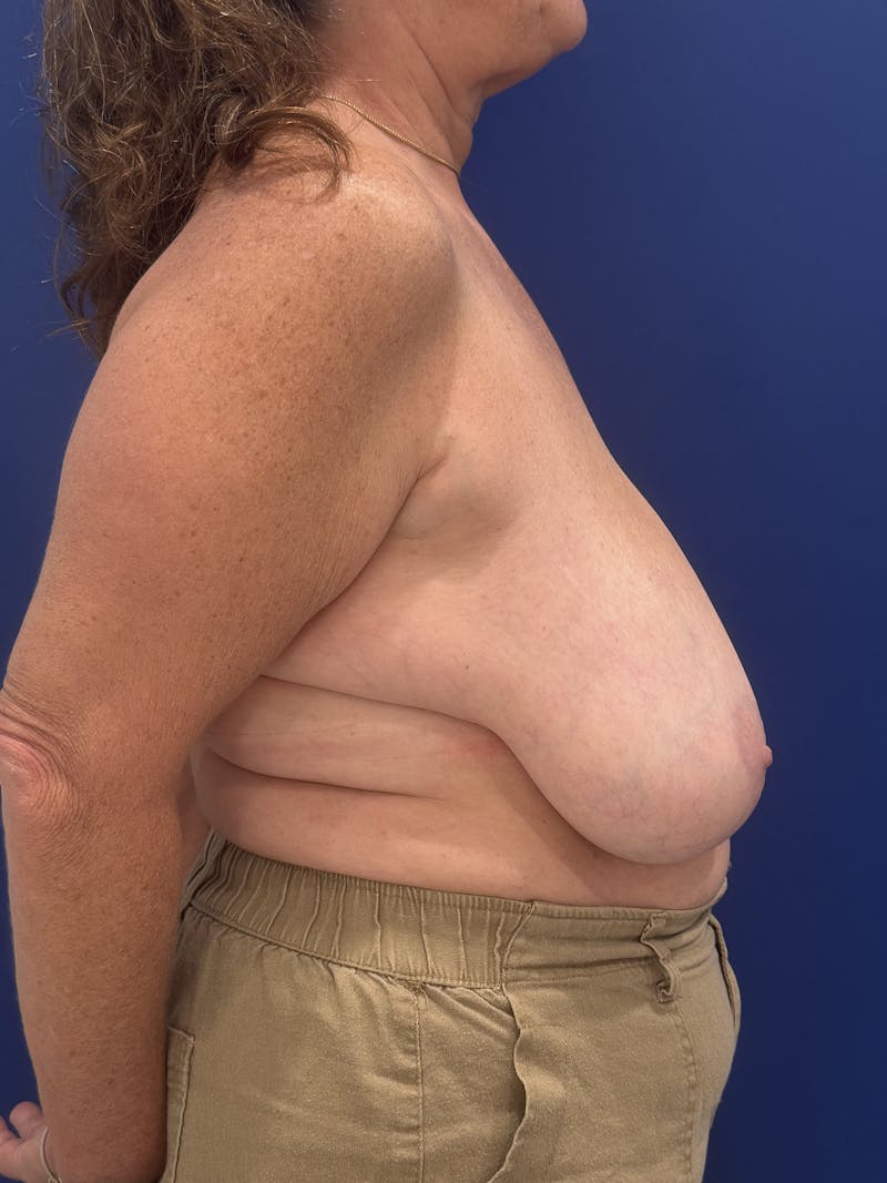 Breast Lift Before & After Gallery - Patient 188277 - Image 10