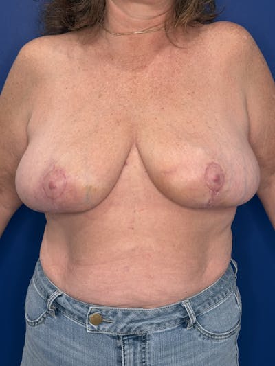 Breast Lift Before & After Gallery - Patient 188277 - Image 1