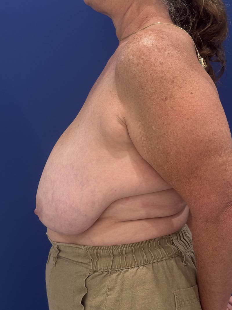 Breast Lift Before & After Gallery - Patient 188277 - Image 7