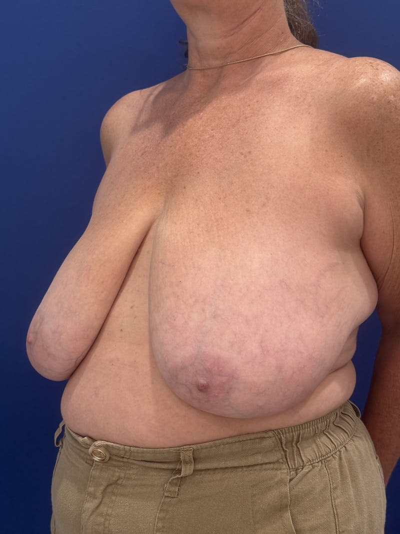 Breast Lift Before & After Gallery - Patient 188277 - Image 8