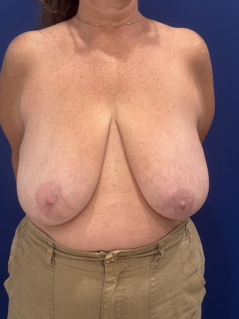 Breast Lift Before & After Gallery - Patient 188277 - Image 9