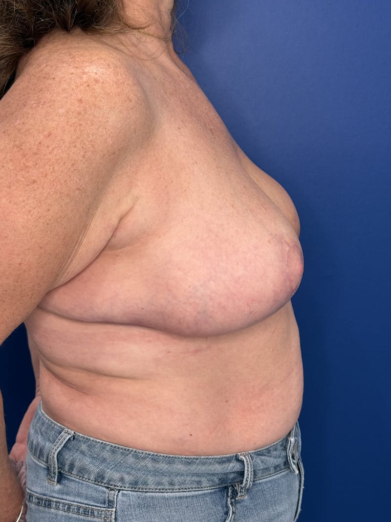 Breast Lift Before & After Gallery - Patient 188277 - Image 6