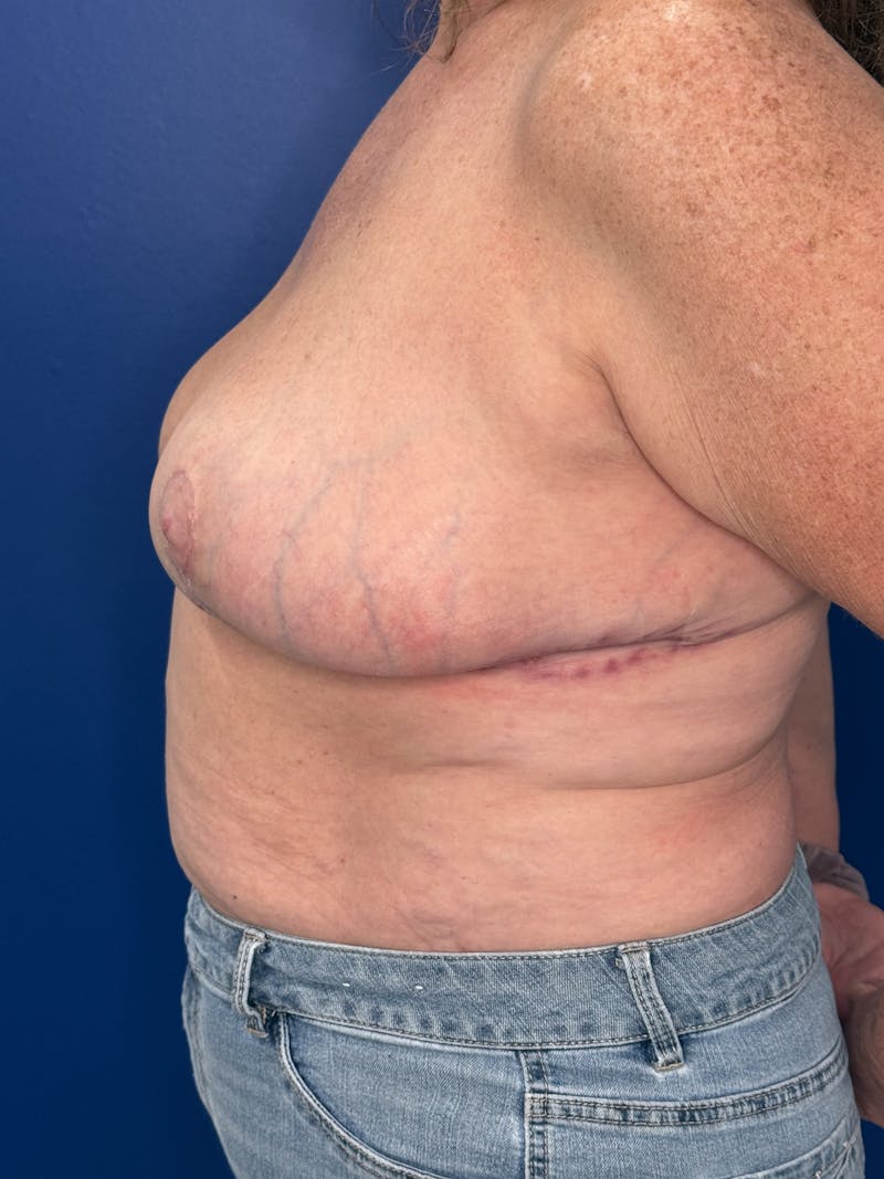 Breast Lift Before & After Gallery - Patient 188277 - Image 4