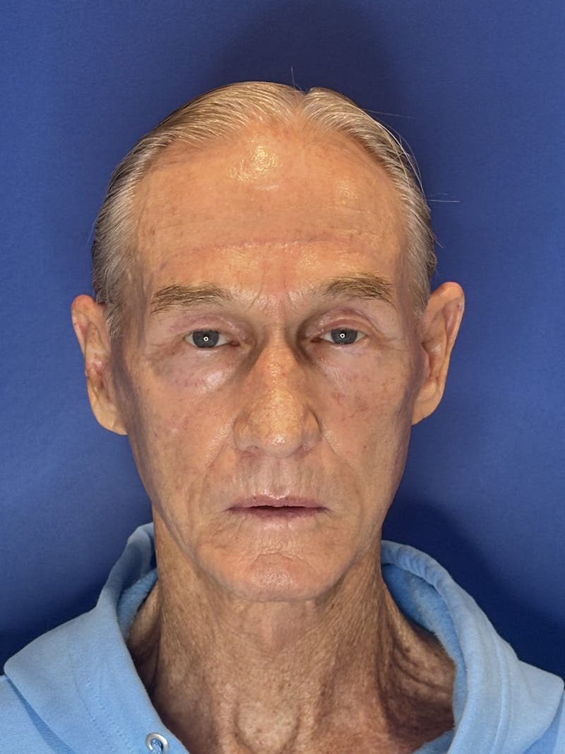 Brow Lift Before & After Gallery - Patient 212623 - Image 4