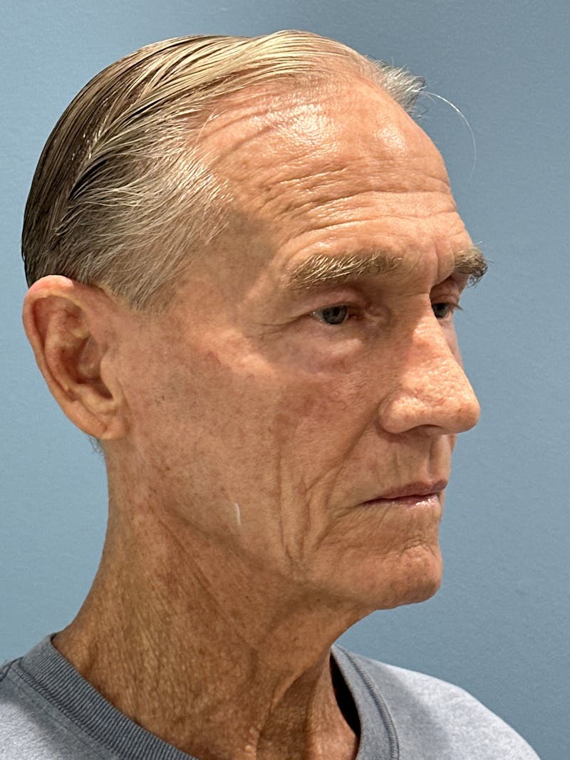 Brow Lift Before & After Gallery - Patient 212623 - Image 5