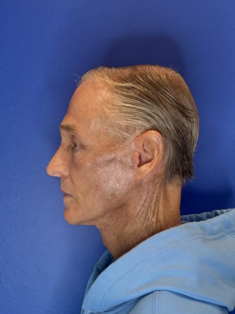 Brow Lift Before & After Gallery - Patient 212623 - Image 16