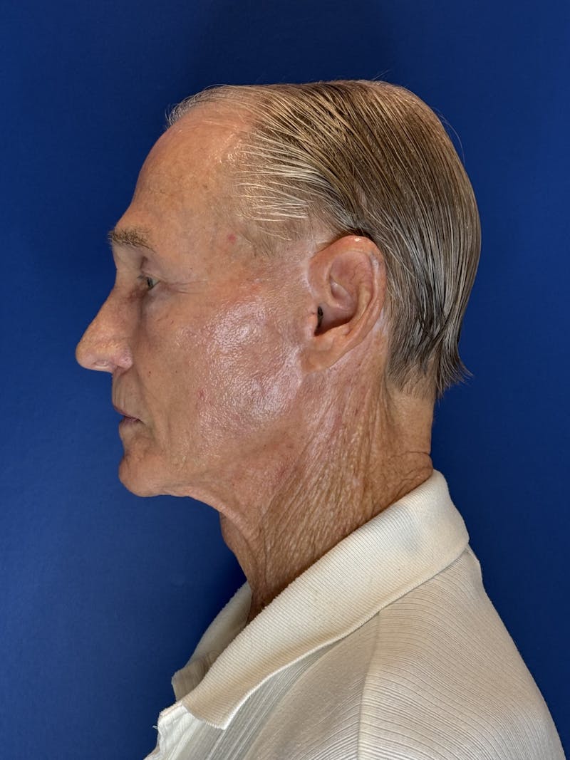 Brow Lift Before & After Gallery - Patient 212623 - Image 12