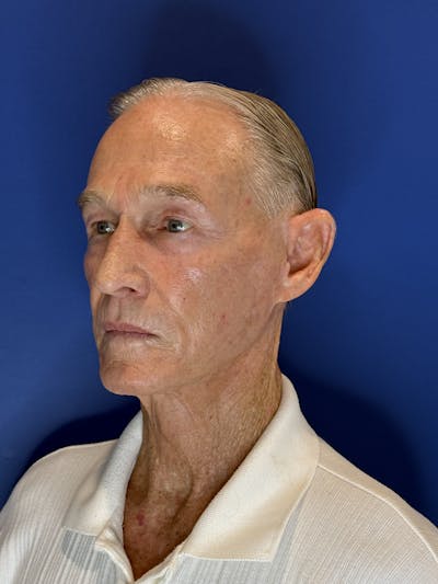 Brow Lift Before & After Gallery - Patient 212623 - Image 2