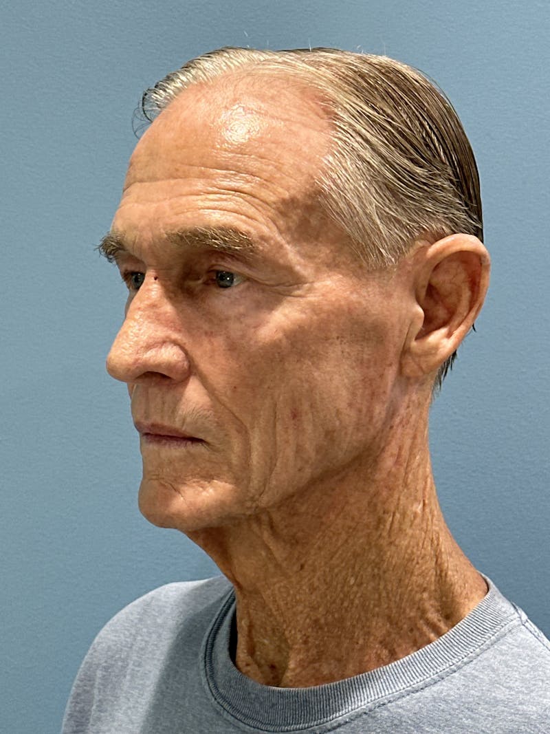 Brow Lift Before & After Gallery - Patient 212623 - Image 9