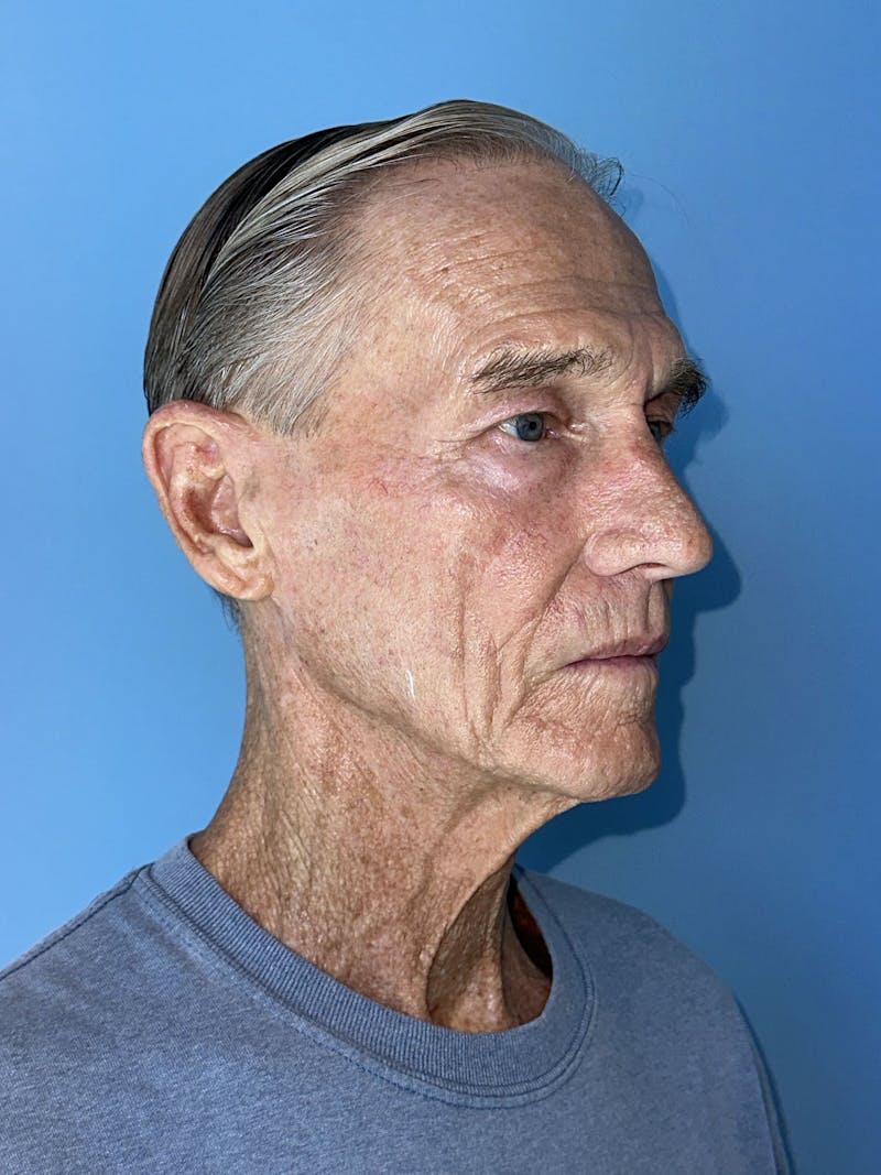 Brow Lift Before & After Gallery - Patient 212623 - Image 17