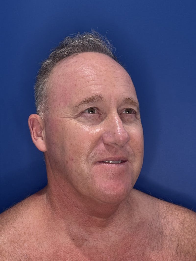 Face Lift Before & After Gallery - Patient 167892 - Image 3