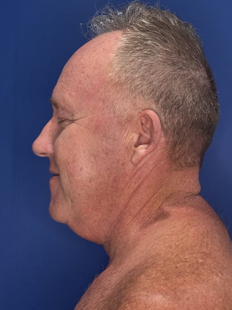 Face Lift Before & After Gallery - Patient 167892 - Image 11