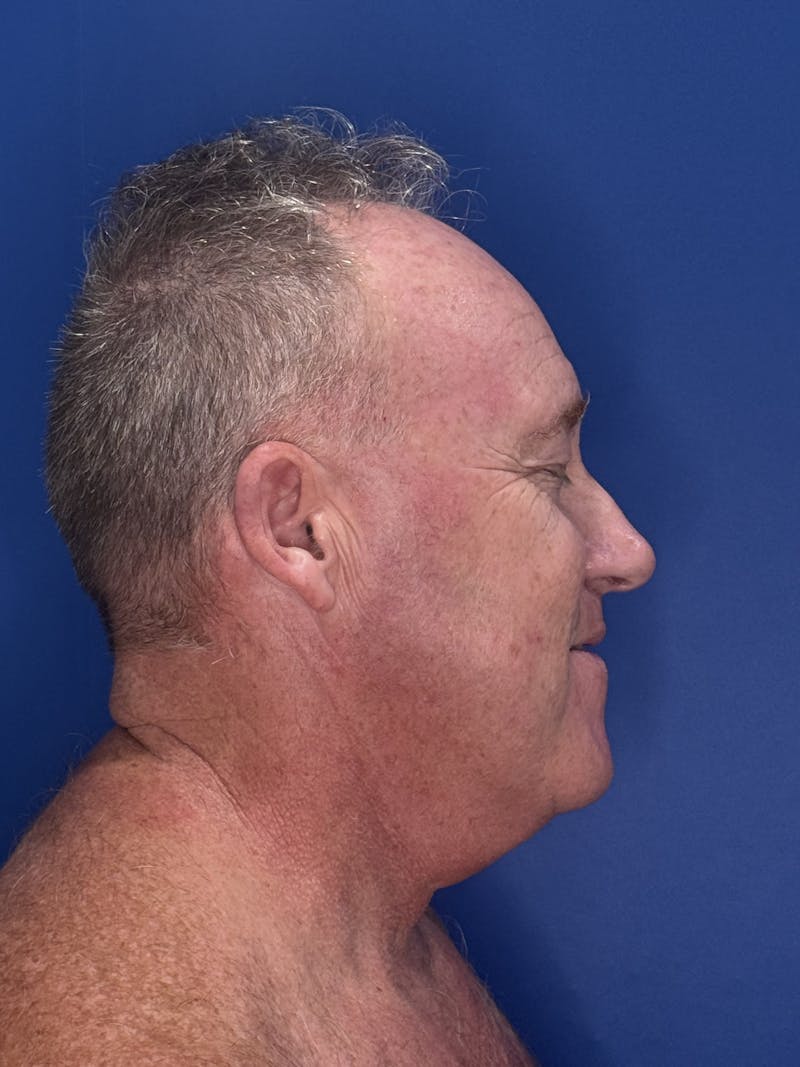 Face Lift Before & After Gallery - Patient 167892 - Image 5
