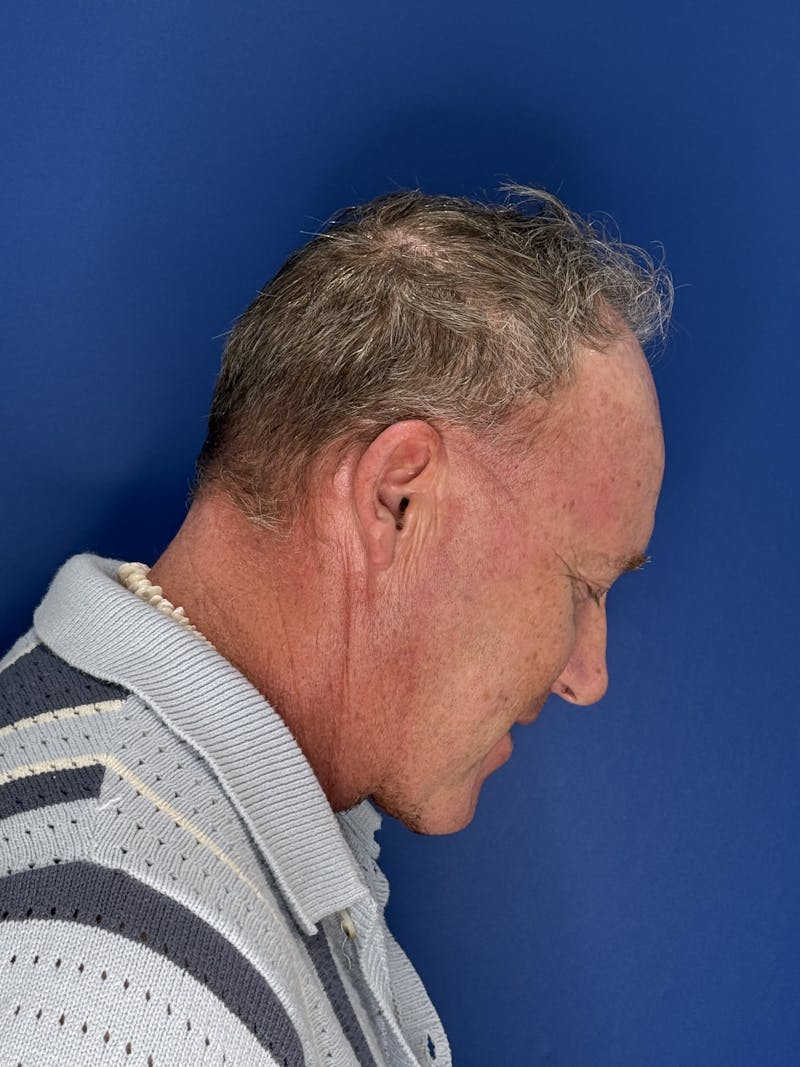 Face Lift Before & After Gallery - Patient 167892 - Image 8