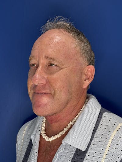 Face Lift Before & After Gallery - Patient 167892 - Image 2