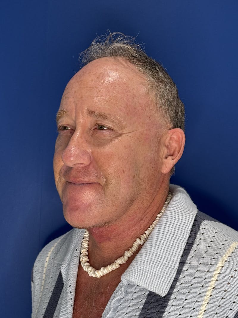 Face Lift Before & After Gallery - Patient 167892 - Image 2