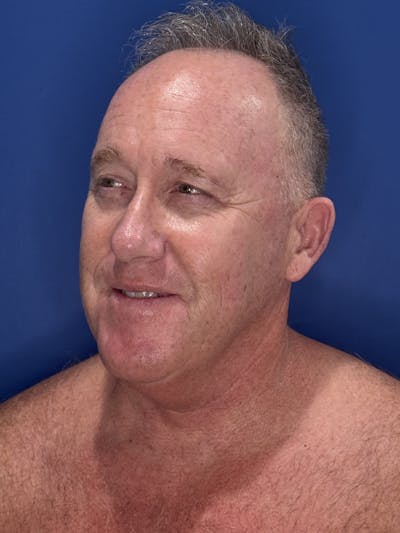 Face Lift Before & After Gallery - Patient 167892 - Image 1