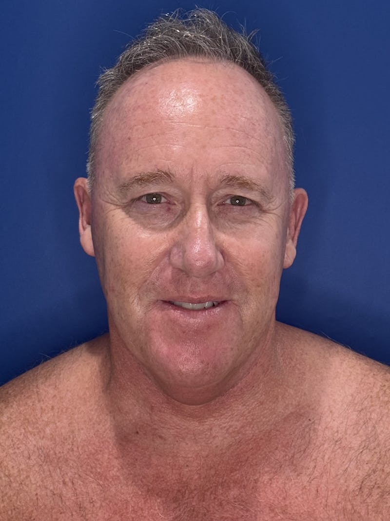 Face Lift Before & After Gallery - Patient 167892 - Image 13